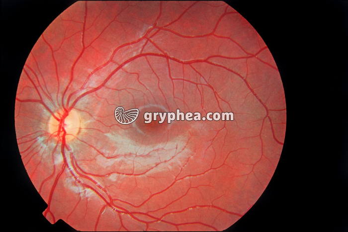 Fond de rétine - gryphea.org